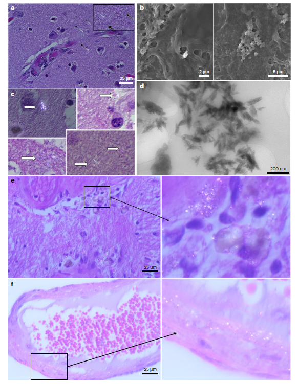 腦組織發現塑膠微粒